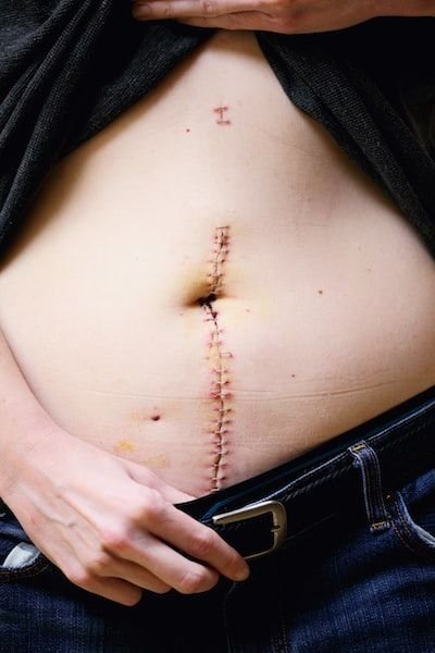 Comment réduire l'abdomen après une césarienne ?